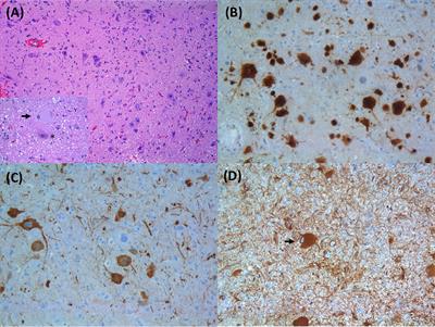 Genomic and Epigenetic Advances in Focal Cortical Dysplasia Types I and II: A Scoping Review